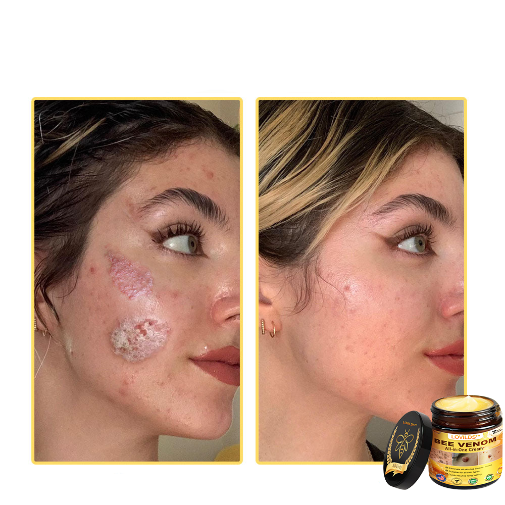 LOVILDS™ Creme multifuncional com veneno de abelha aprovado por dermatologistas dos EUA