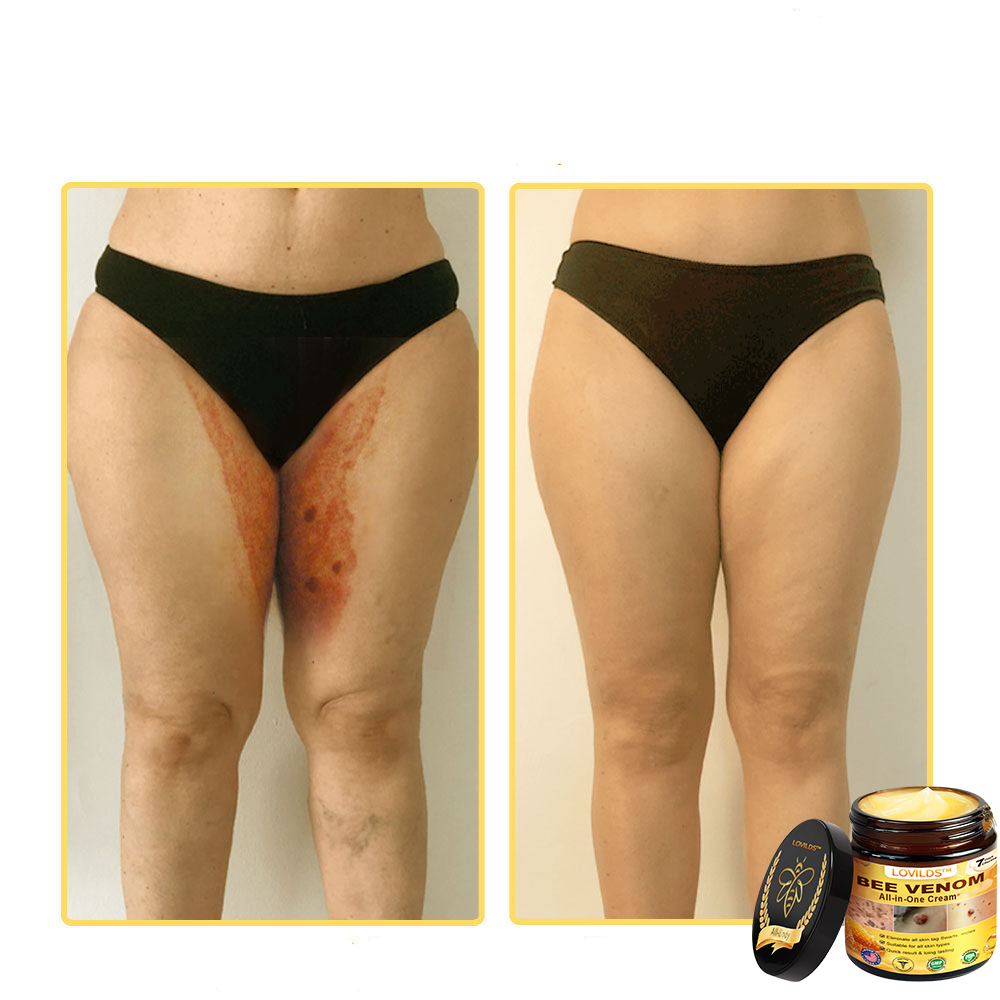 LOVILDS™ Creme multifuncional com veneno de abelha aprovado por dermatologistas dos EUA