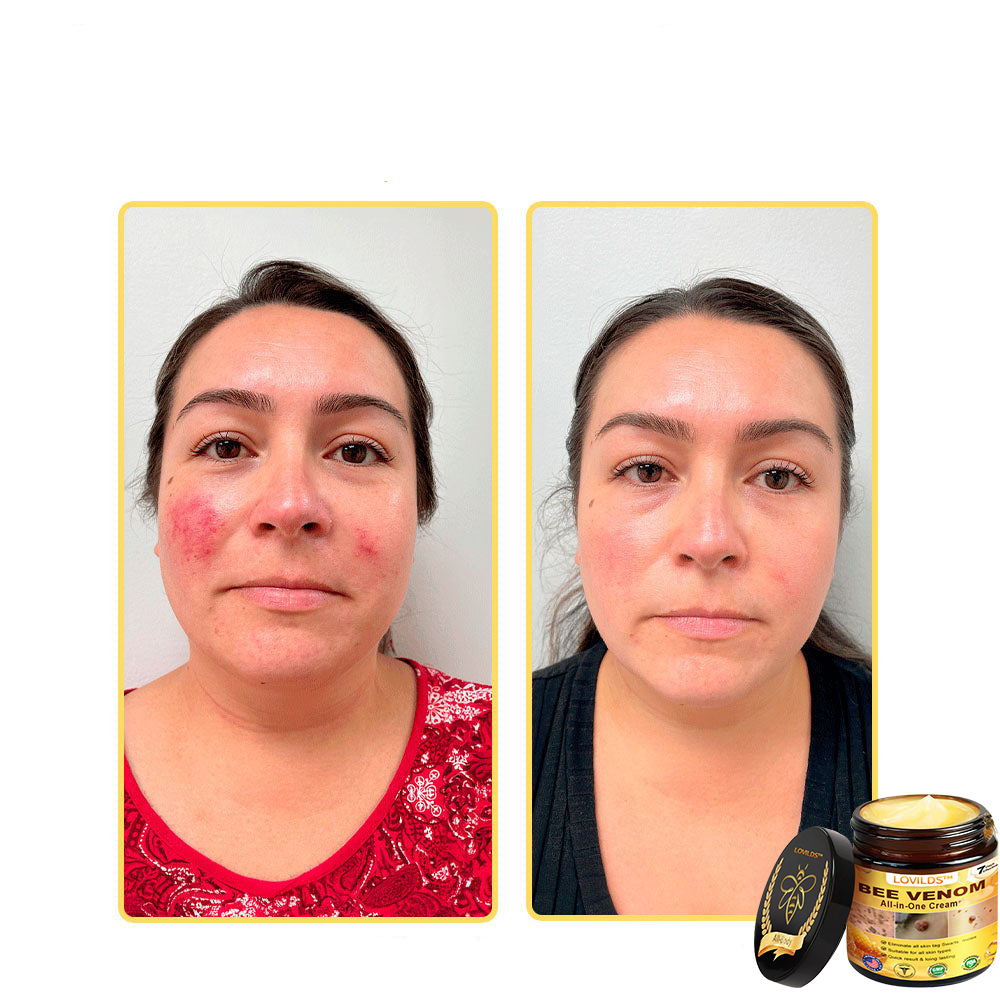 LOVILDS™ Creme multifuncional com veneno de abelha aprovado por dermatologistas dos EUA