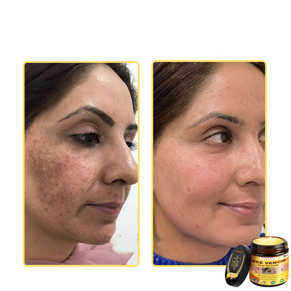 LOVILDS™ Creme multifuncional com veneno de abelha aprovado por dermatologistas dos EUA