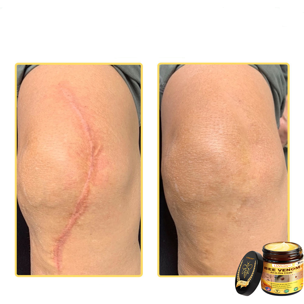 LOVILDS™ Creme multifuncional com veneno de abelha aprovado por dermatologistas dos EUA