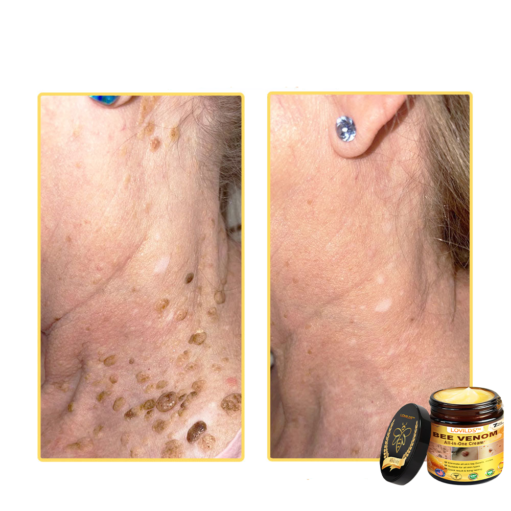 LOVILDS™ Creme multifuncional com veneno de abelha aprovado por dermatologistas dos EUA